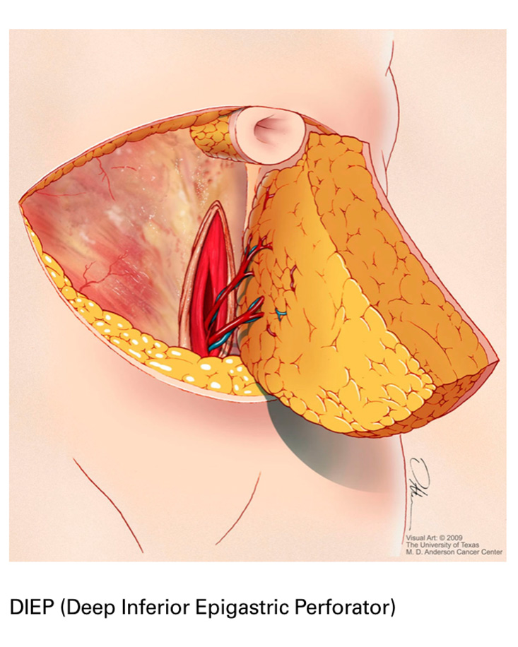 medical illustration of deep inferior epigastric perforator