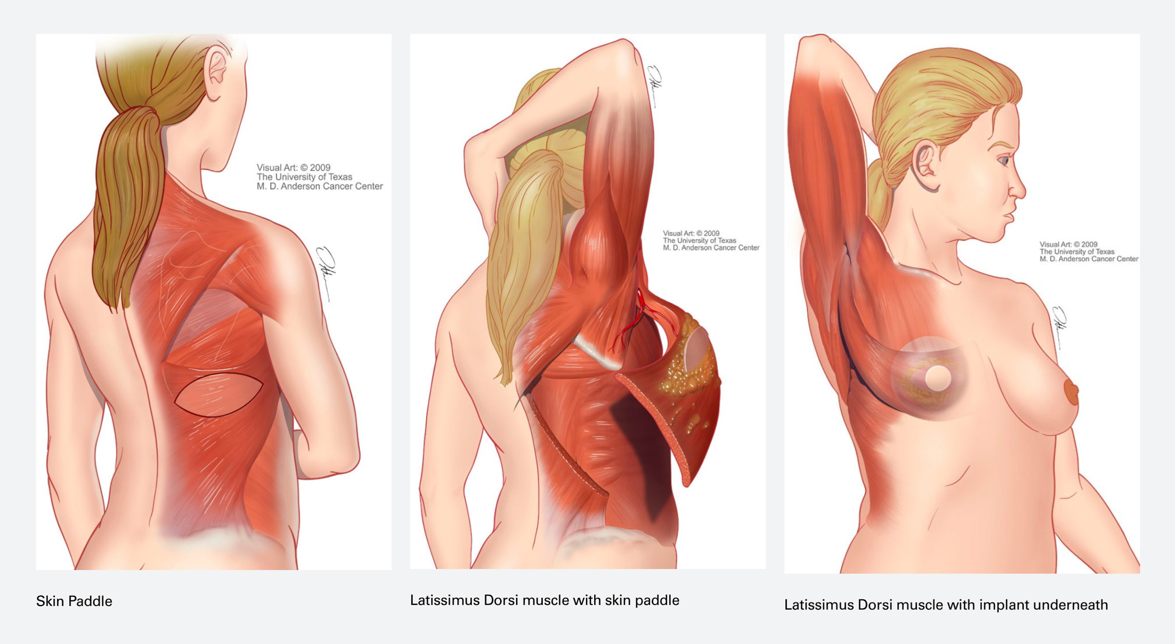 a medical illustration of latissimus dorsi flaps