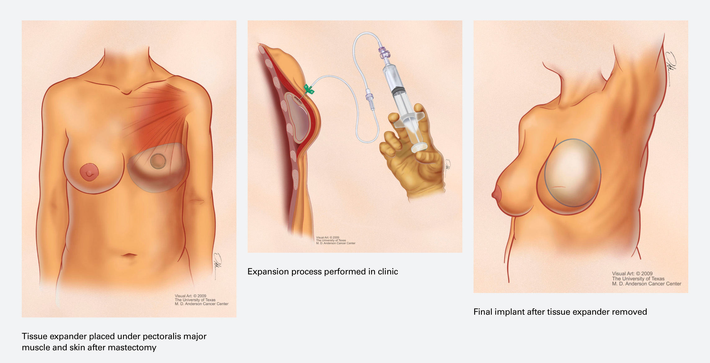 Medical illustrations showing the process of tissue expansion for a breast reconstruction procedure